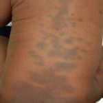 Bercak Mongol Tanda Lahir Yang Sering Di Temukan Pada Bayi