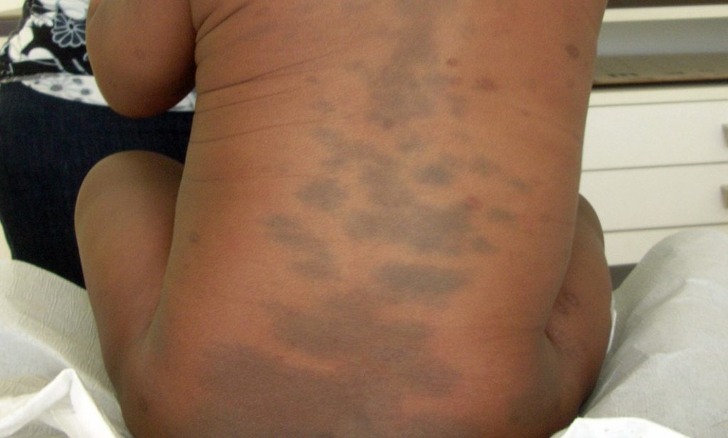 Bercak Mongol Tanda Lahir Yang Sering Di Temukan Pada Bayi